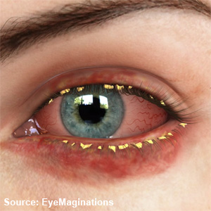 Inflamed eyelids - RightDiagnosis.com