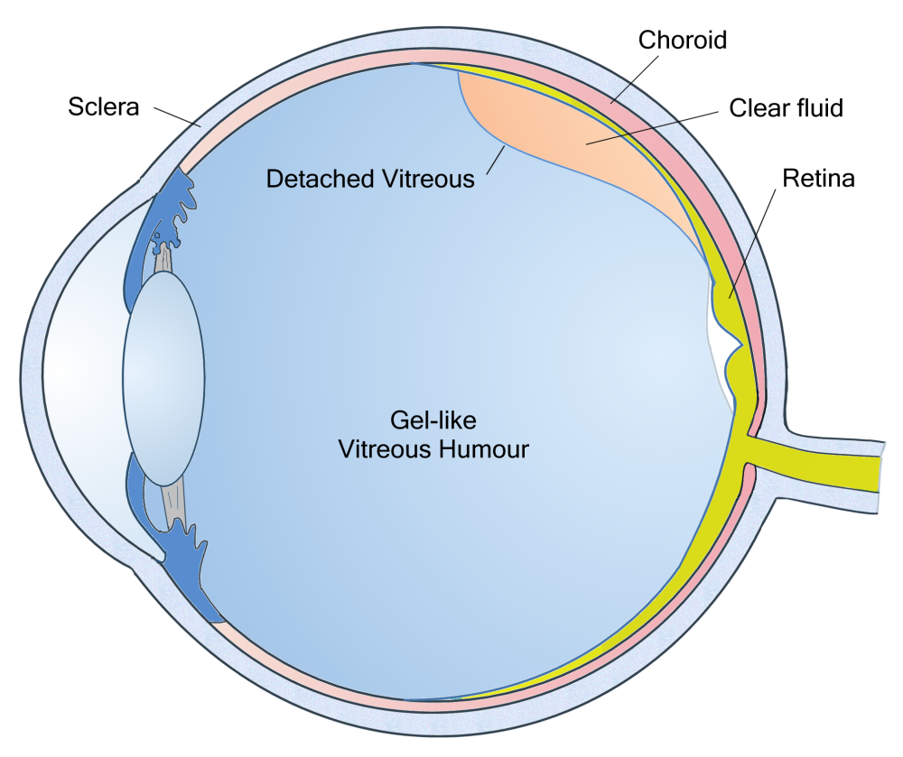 Vitreous Detachment Information, Symptoms - Posterior Vitreous 