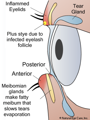 Inflamed Eyelids