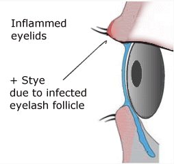 Antibiotic Eye Cream For Blepharitis