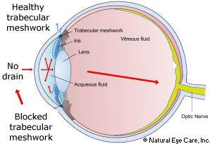 Glaucoma