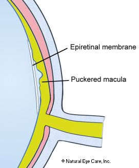 Macular Pucker / Epiretinal Membrane