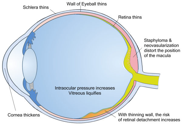 myopic macular degeneration
