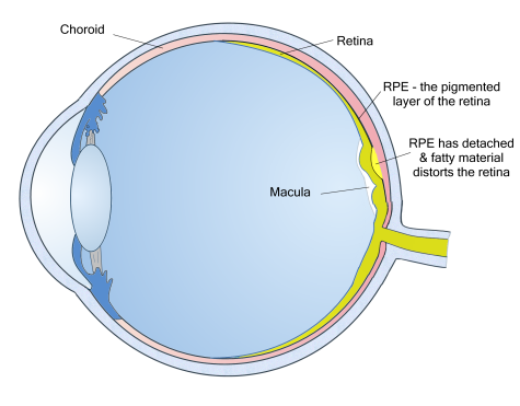 eye care for the adirondacks in plattsburgh new york