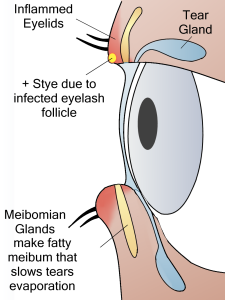 Inflammed Eyelids