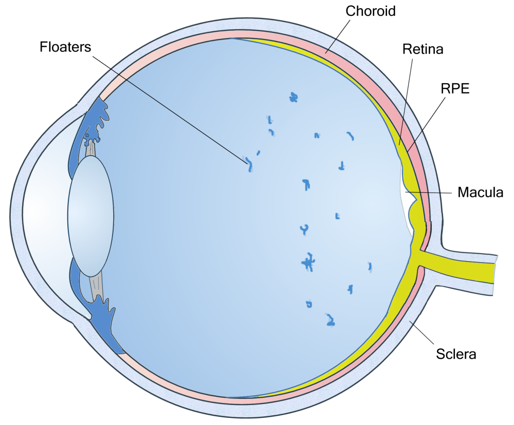 eye floaters pictures