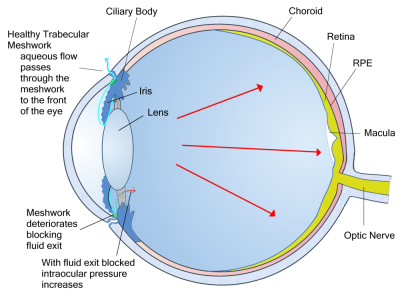 Clogged Meshwork causes Glaucoma Glaucoma