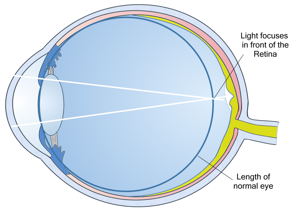 What is myopic eye disease?