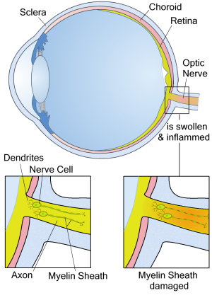 swollen optic nerve