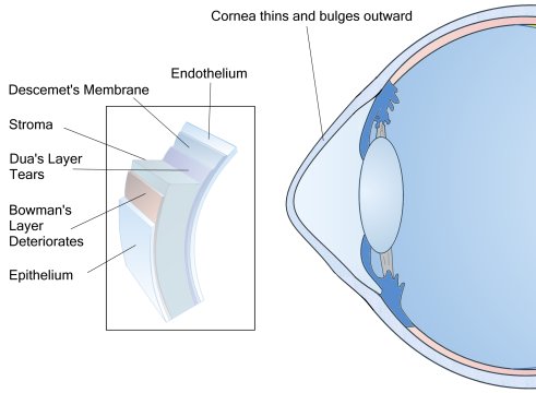 Keratoconus