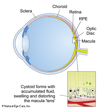 macular edema diagram