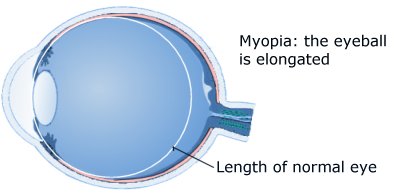 myopia