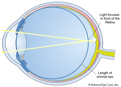 myopia