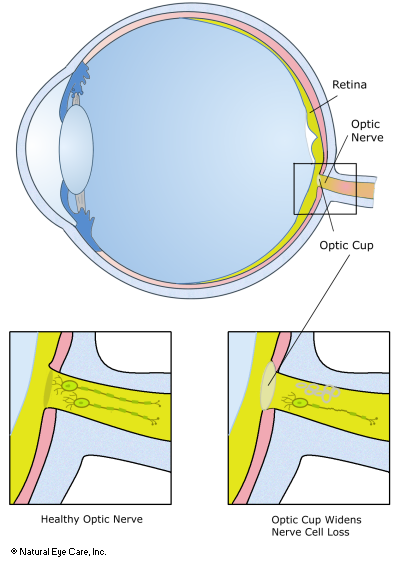 optic nerve atrophy