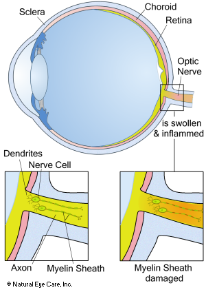 swollen optic nerve