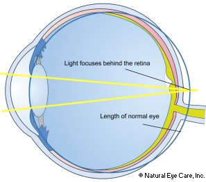 Presbyopia & Hyperopia
