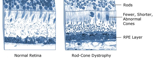 rod cone dystrophy