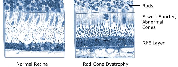 rod cone dystrophy