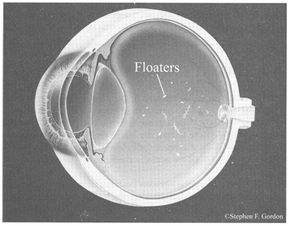 floaters eye dissolve ever assured otherwise brightness regular much screen she