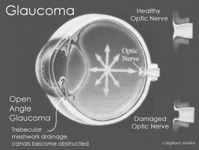 glaucoma