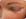 Blepharitis