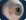 pterygium
