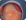 Retinal Detachment