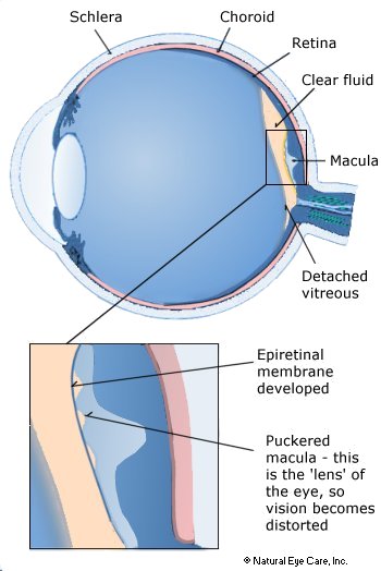 macular pucker