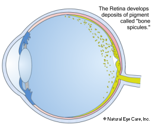 Retintis Pigmentosa